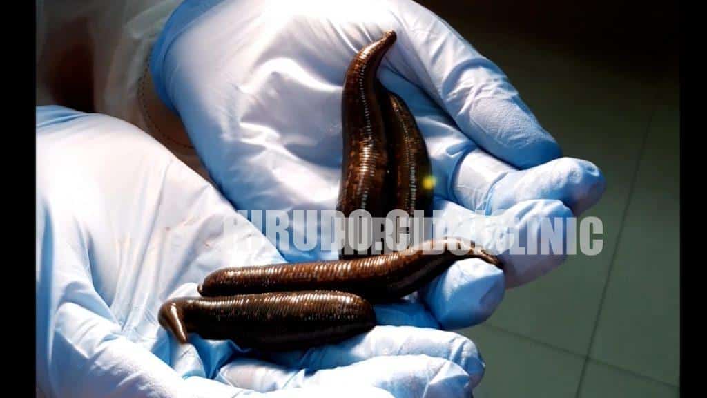At Hirudo.Clinic, our leeches are kept in controlled aquaculture systems, not just jars, to preserve their full therapeutic potential.