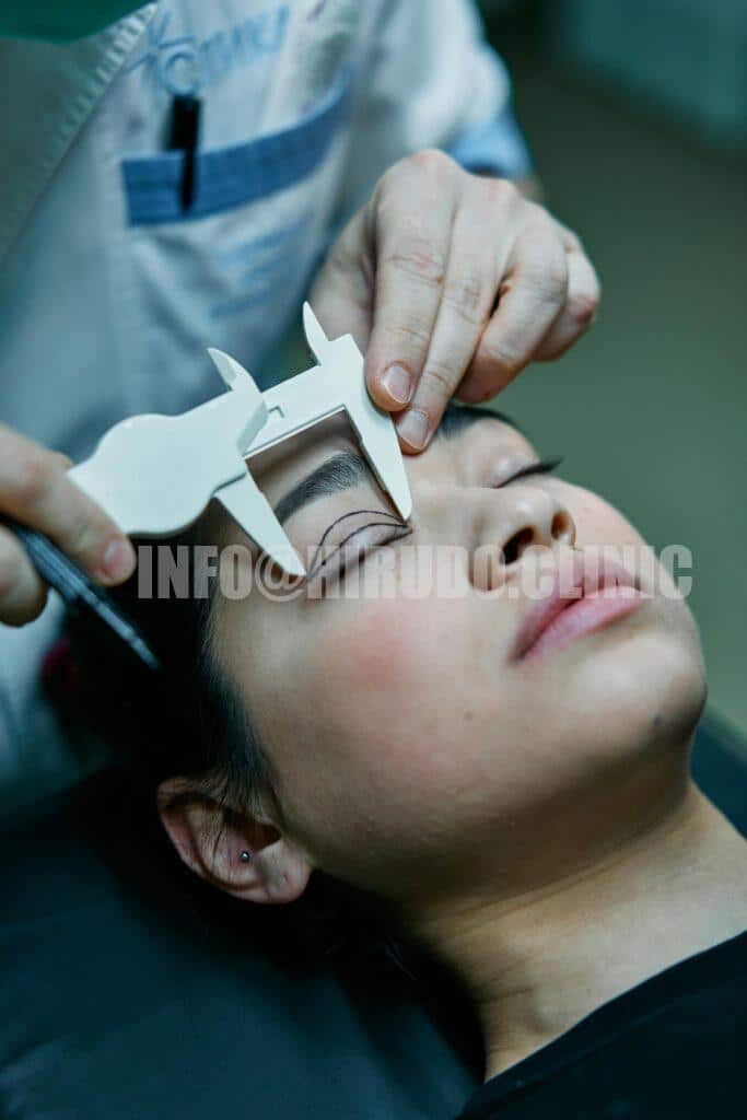 Service Plan for Post-Blepharoplasty Leech Therapy