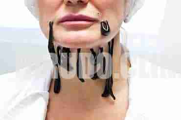 Over time, the skin loses elasticity, and the contours of the lower face