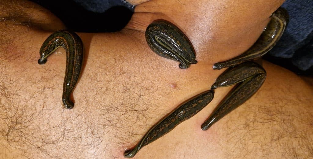 During the treatment, we applied five medicinal leeches to the client's upper shoulder area, focusing on spots where tension and discomfort often build up.