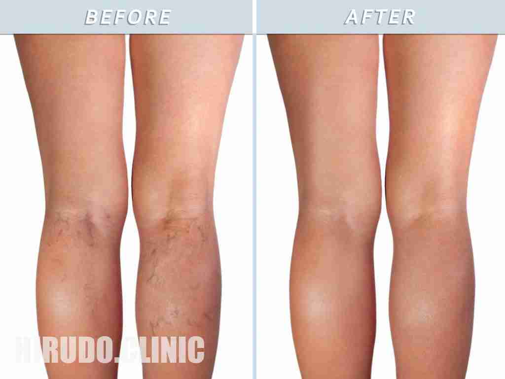Healthy leg and the affected varicose veins Leech therapy for varicose veins yields remarkable results, with significant improvements seen after six treatments over a two-month period.