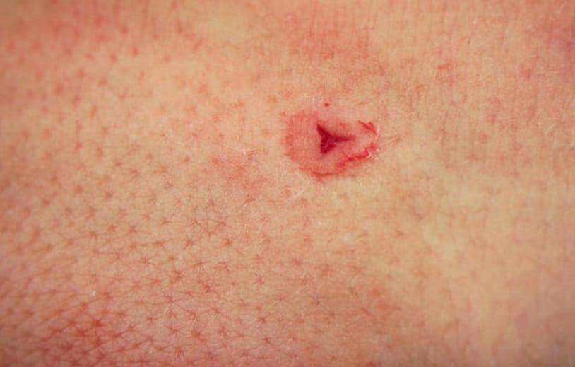 When a medical leech bites, it often leaves a mark resembling a Mercedes-Benz logo, with a triangular or Y-shaped opening.