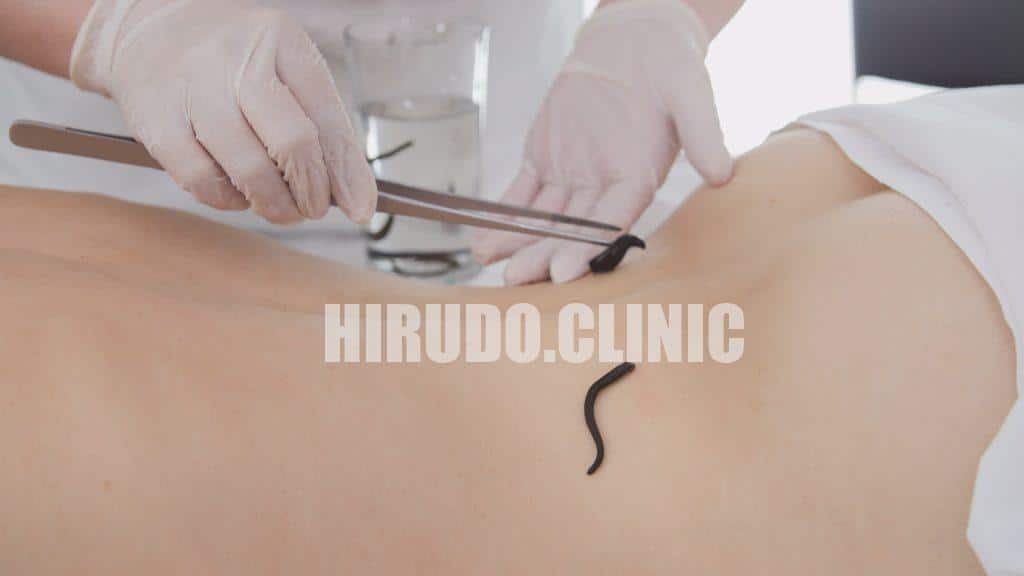 How Hirudo Therapy Helps with Back Pain?