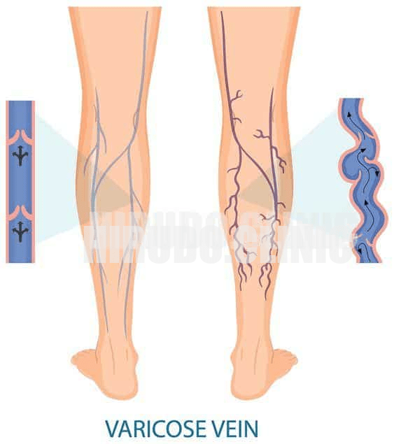 Varicose veins are enlarged, twisted veins that usually appear in the legs due to weakened vein walls and valves, causing blood to pool and veins to swell. They often look blue or purple and can cause discomfort, swelling, or aching