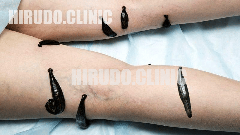 A Hirudotherapy session lasts about 45 minutes. Afterward, you’ll receive aftercare instructions to support healing. For varicose veins, the therapist avoids placing leeches directly on the affected veins to prevent bleeding, selecting areas on the lower limbs without major blood vessels. The leeches are arranged in a staggered pattern, with typically 2-4 leeches used per vein. The session ends when the leeches naturally detach after feeding.