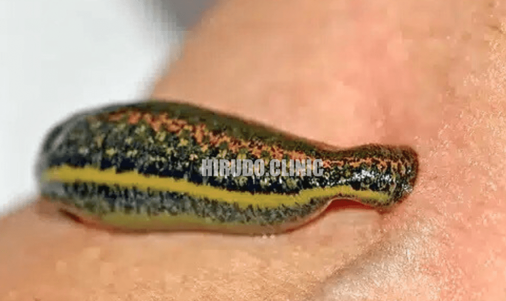 During the therapy, leeches are placed on the body according to your specific treatment plan.