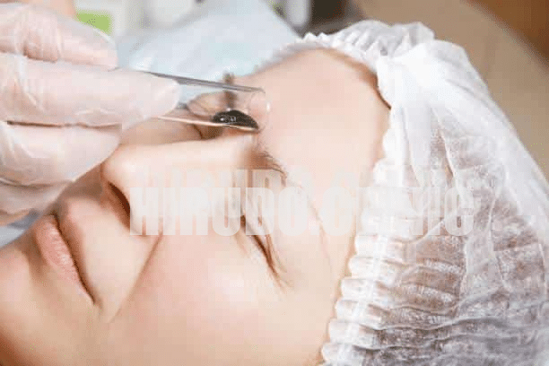 image The zone between the eyebrows, often referred to as the "third eye," is a highly effective target in leech therapy