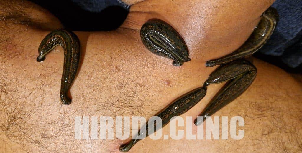 Leech therapy for back pain Leech therapy for back pain