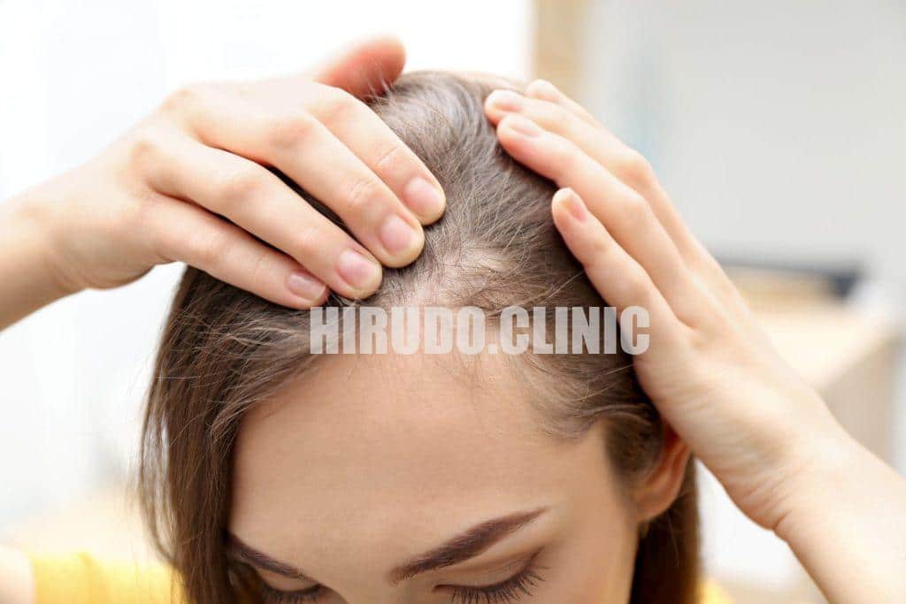 Leech Therapy for Hair Loss: A Natural Approach to Regrowth