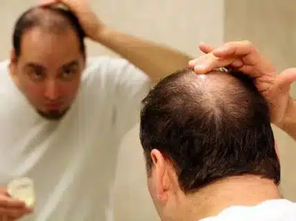 Leech Therapy for Hair Loss