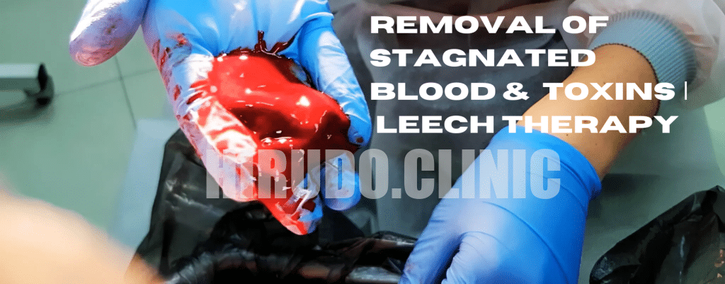 Removal of stagnated blood & toxins Leech Therapy
