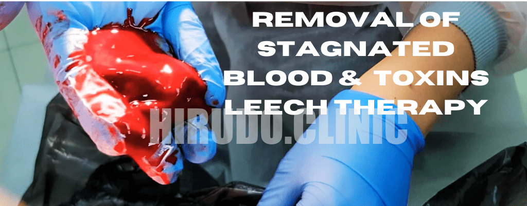 Removal of stagnated blood & toxins Leech Therapy (2) Remove Toxins Naturally: Leech Therapy for Detoxification and Anti-Aging