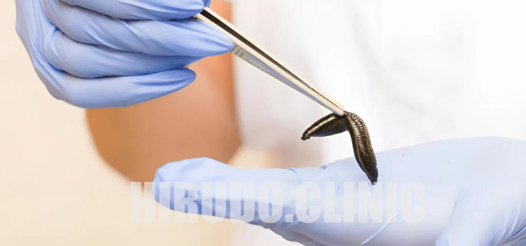 Leech therapy as a pre-treatment before invasive cosmetic procedure