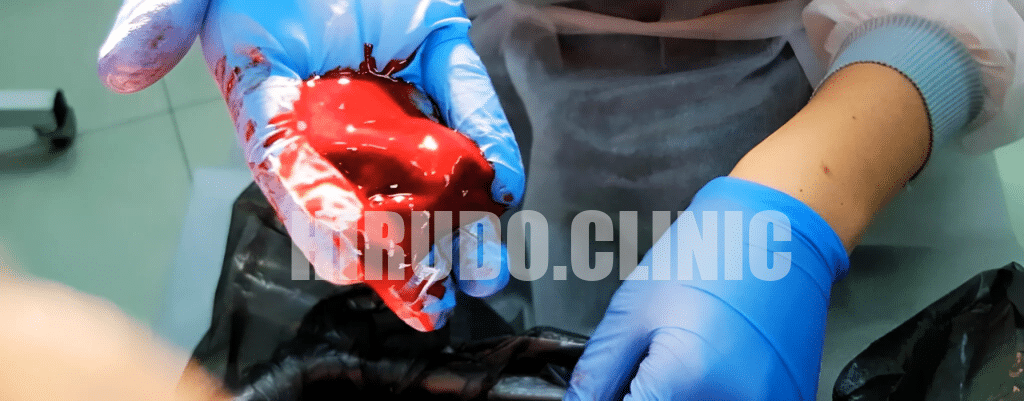 removal of stagnated blood & toxins from Gums After Leech Therapy Clinician holding a blood clot expelled during leech therapy session for women's health