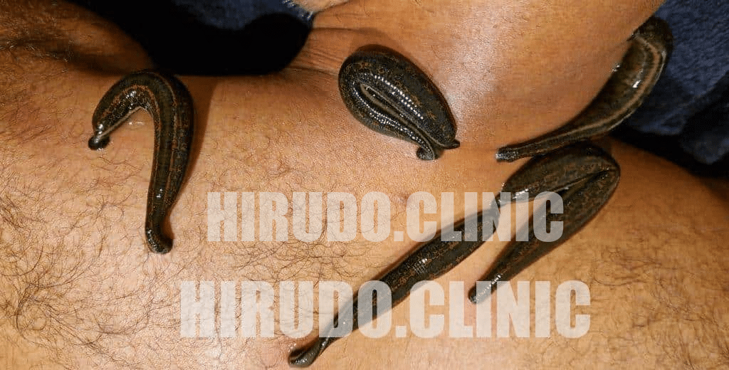Effective Leech Therapy for Alleviating Upper Back Pain around the T1-T4 and T5-T8 vertebrae