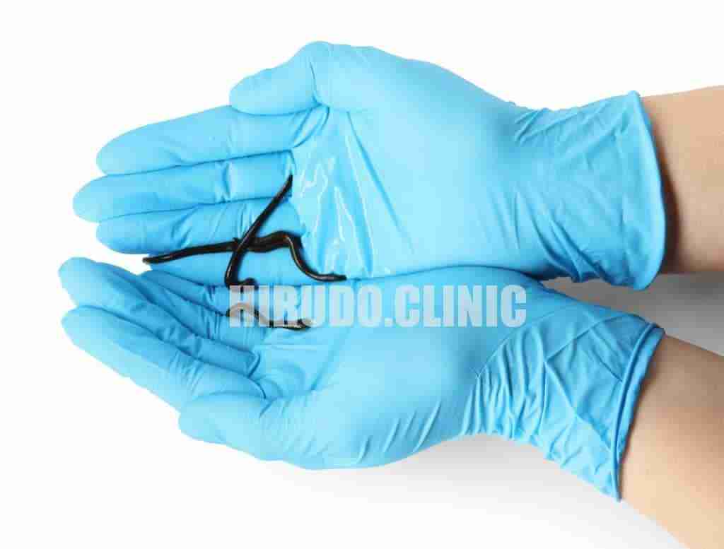 Discover professional mobile leech therapy services in London’s Zones 1 and 2. Certified therapists delivering hirudotherapy to your home for pain relief, improved circulation, and detoxification.