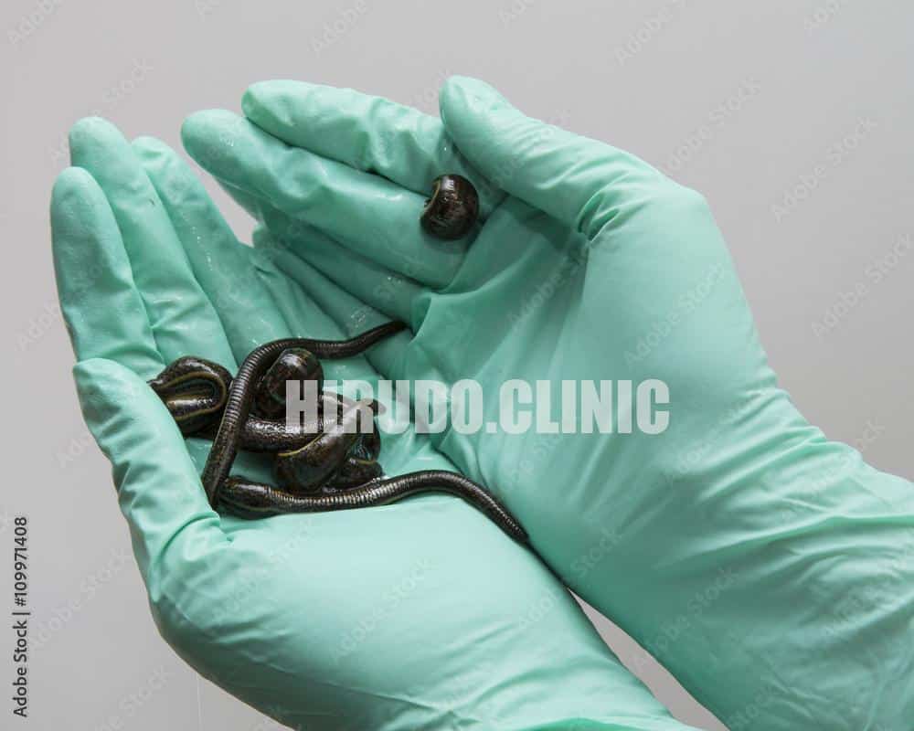 Ощутите целебные свойства пиявкотерапии Experience the Healing Benefits of Leech Therapy