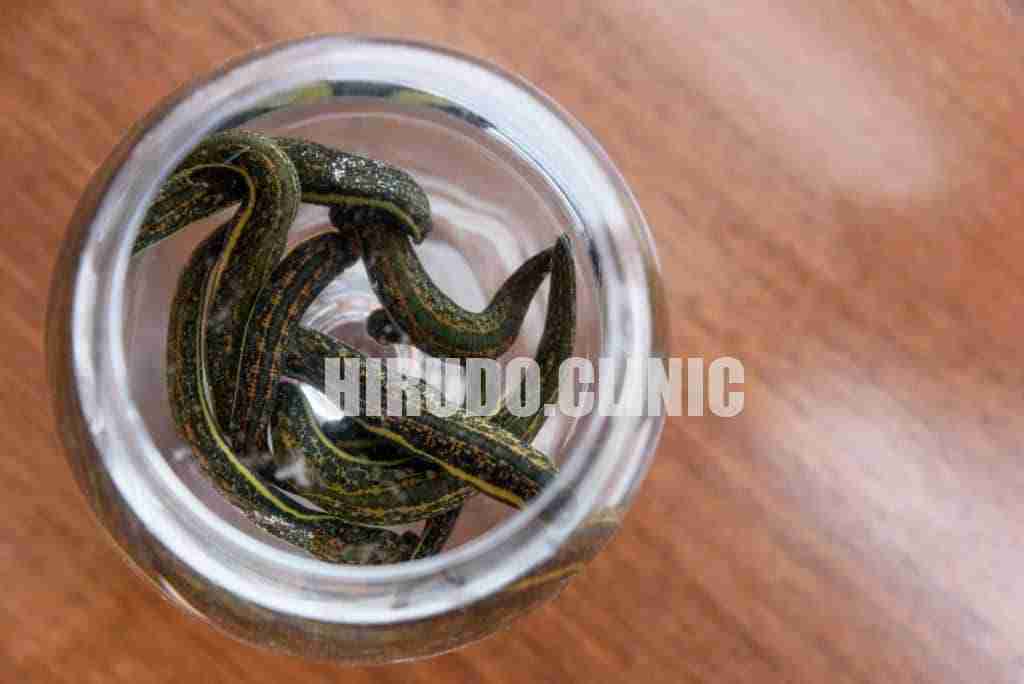 Medical leeches therapy. Hirudo medicinalis in a container with water. How Many Leeches Are Needed for Hirudotherapy