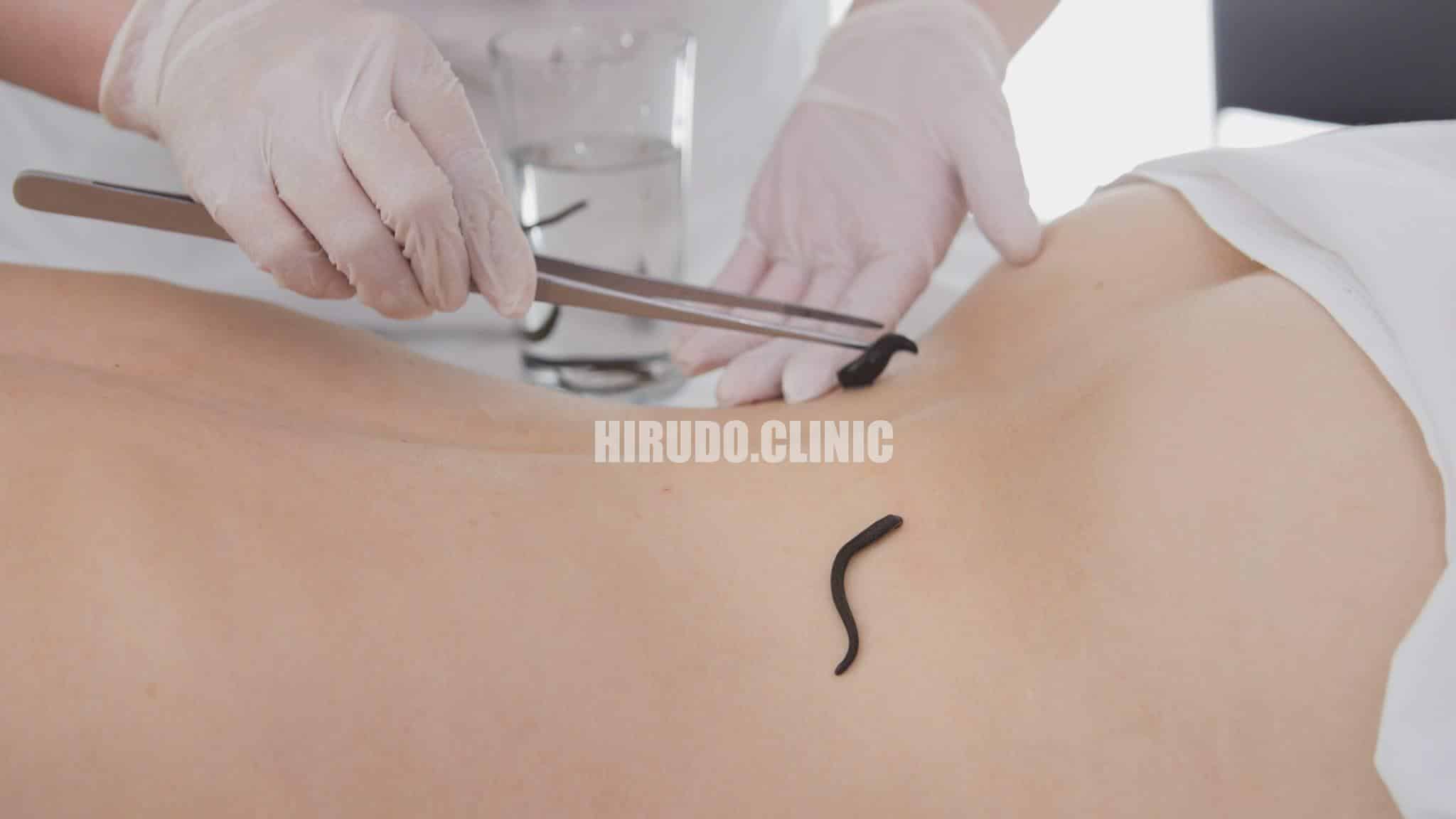 Hirudo Therapy, also known as leech therapy, is an ancient practice that has been modernized for today’s medical needs. Medicinal leeches (Hirudo medicinalis) are carefully applied to the skin, where they release a unique blend of bioactive compounds