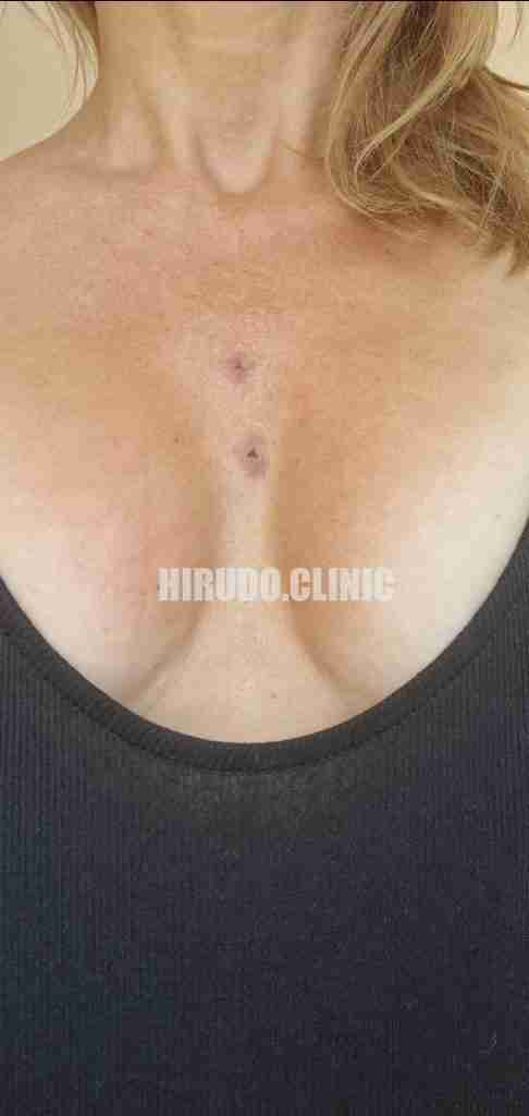 Leech therapy effectively targets hormonal imbalances and supports glandular health, particularly when applied to the upper chest area, which is close to the thymus gland. The thymus plays a vital role in immune regulation and hormonal interaction, making this region a suitable target for therapeutic leech applications. Leech therapy effectively targets hormonal imbalances and supports glandular health, particularly when applied to the upper chest area, which is close to the thymus gland. The thymus plays a vital role in immune regulation and hormonal interaction, making this region a suitable target for therapeutic leech applications.