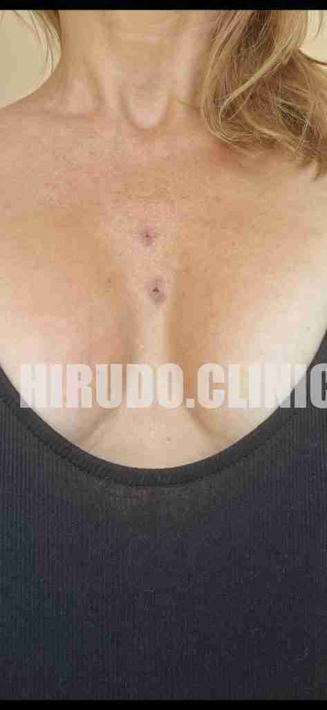 Leech therapy applied to the upper chest for hormonal balance can be a powerful tool for addressing thyroid-related issues and promoting general well-being. This holistic approach has shown significant benefits, including a boost in mood and improved systemic health.