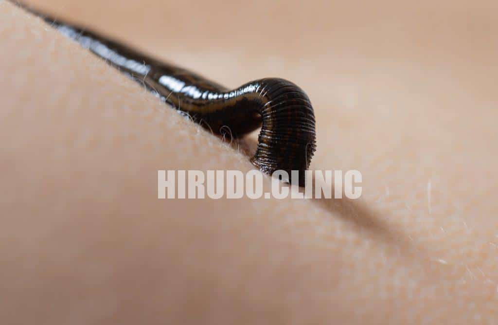 What Causes an Allergy to Leech Saliva?