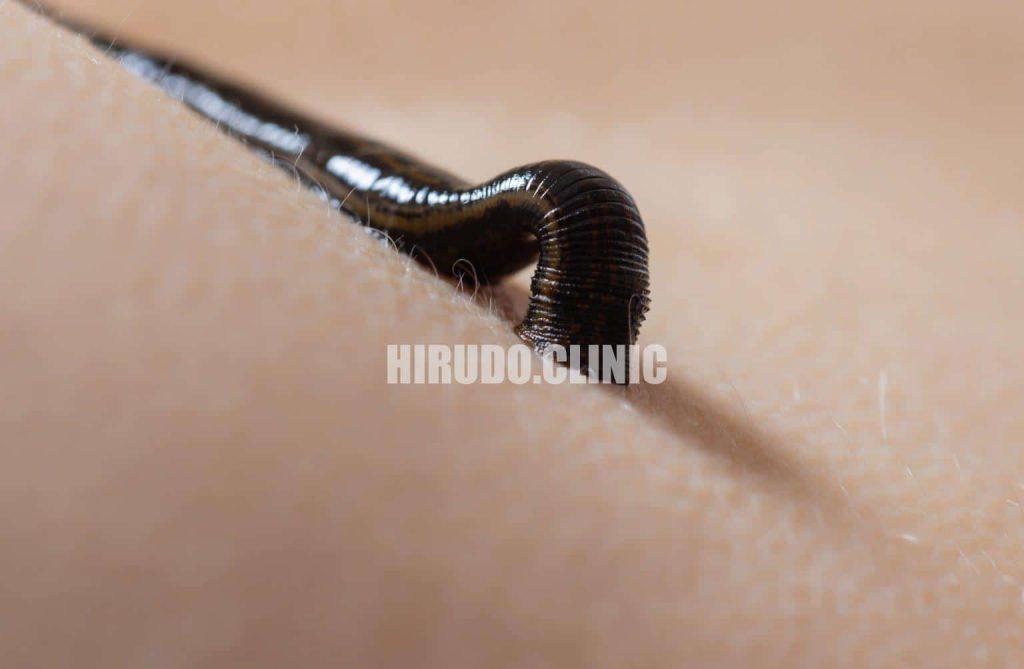 What Happens During a Medicinal Leech Bite?