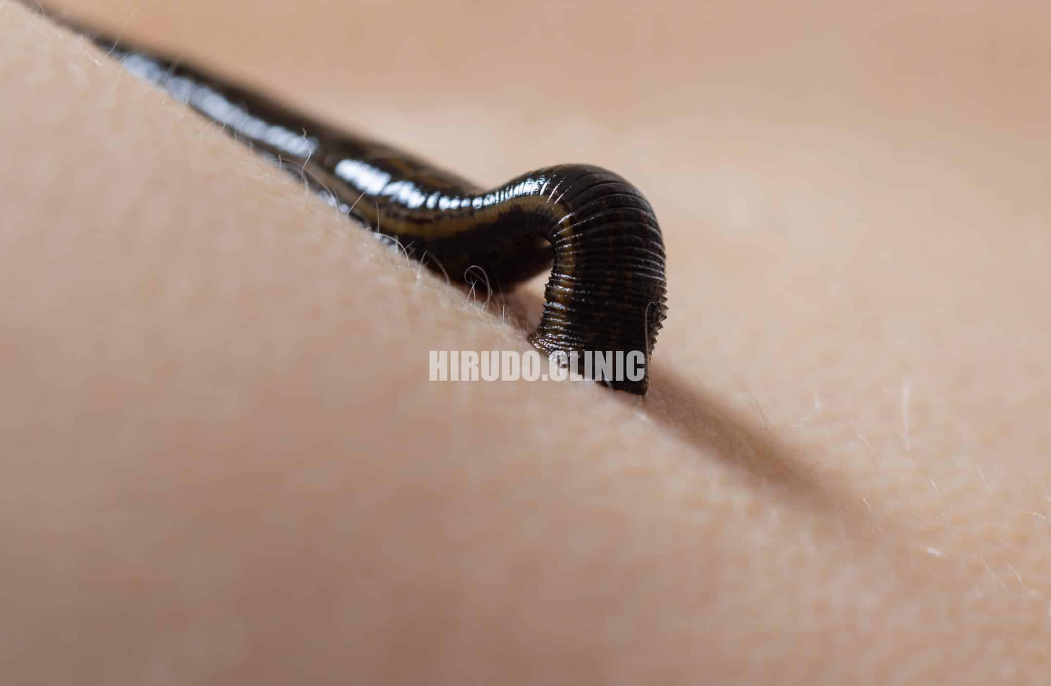 Leech Rash What Causes an Allergy to Leech Saliva? - HIRUDO CLINIC