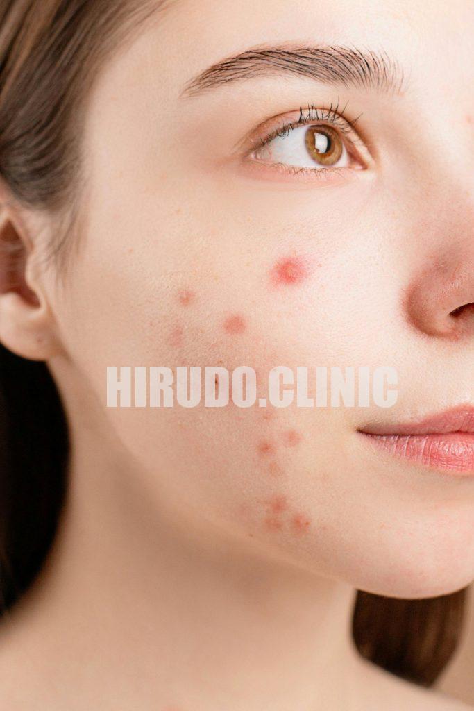 Natural detoxification paired with Medicinal Leech Therapy (MLT) can create a powerful synergy for improving skin clarity and reducing acne-related inflammation. Natural detoxification paired with Medicinal Leech Therapy (MLT) can create a powerful synergy for improving skin clarity and reducing acne-related