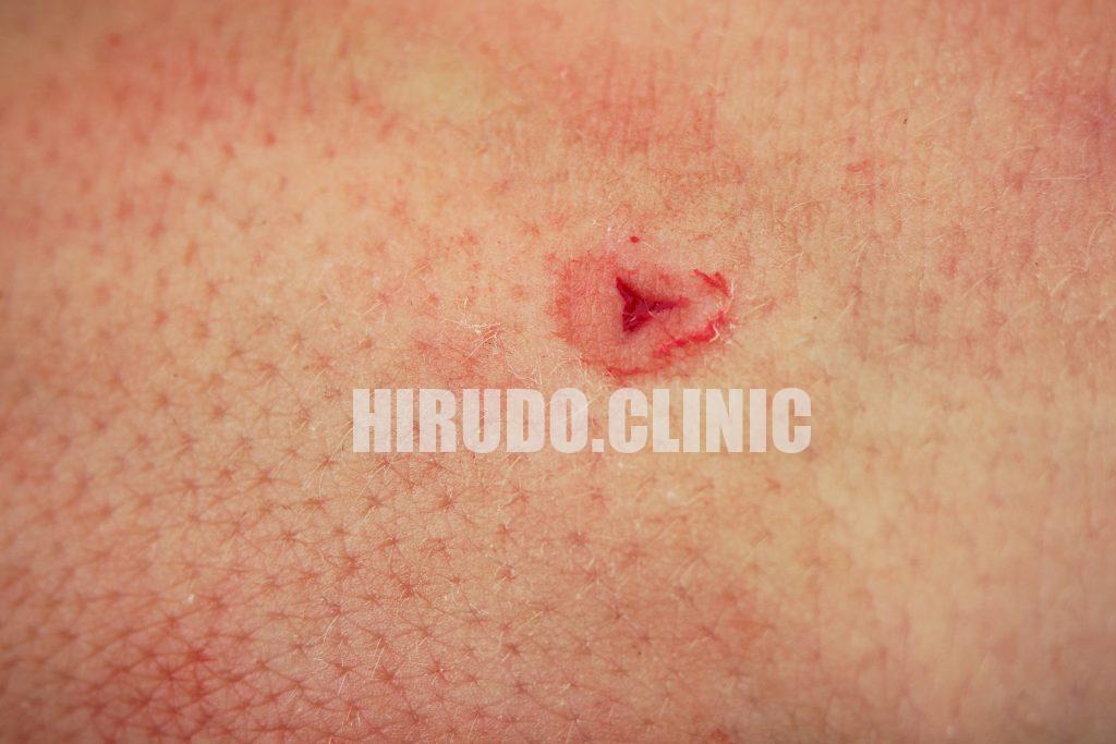 Medicinal Leech - Hirudo medicinalis - leech bite, typical triangle leech bite after sucking blood on the human body Leeches bite like a quick pinprick, then release a mild anesthetic. Most people feel only warmth.