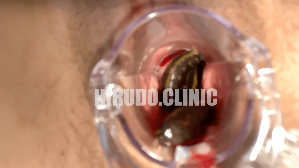 While medicinal leech therapy is generally safe when performed correctly, there is a potential risk of infection.