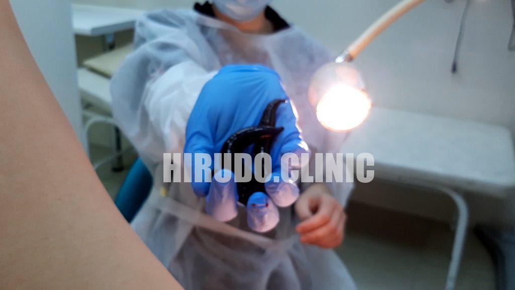 польза от лечения пиявками_лекарственная терапия пиявками011 Leech therapy, or hirudotherapy, is a centuries-old treatment