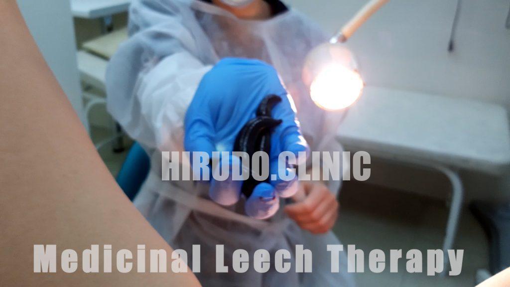 leech therapy benefits_medicinal leech therapy014131 intravaginal leech therapy may improve microcirculation