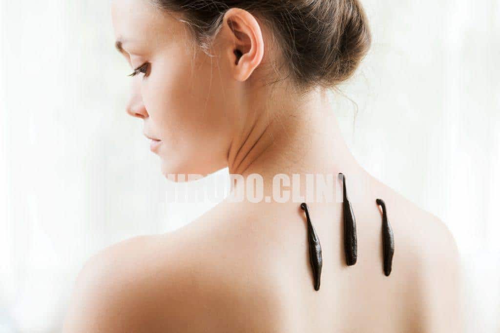 The girl with bloodsuckers on a back on a white background. 📍 Hirudo.Clinic – Leech Therapy in London