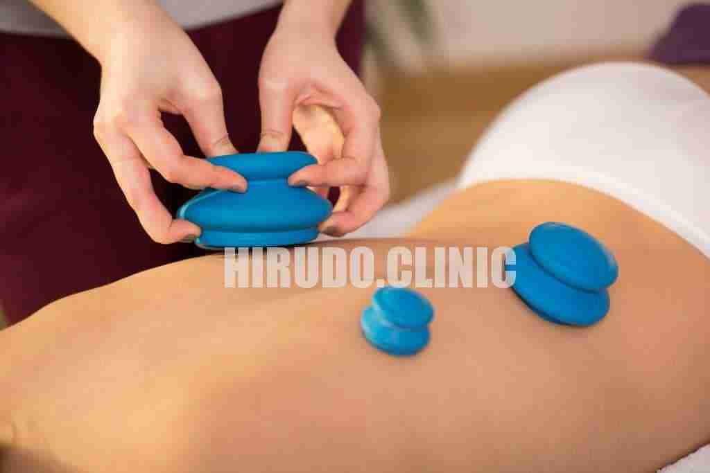 At Hirudo.clinic in Knightsbridge (SW1), we proudly offer the complete spectrum of cupping therapy techniques. At Hirudo.clinic in Knightsbridge (SW1), we proudly offer the complete spectrum of cupping therapy techniques. From gentle dry cupping and time-honoured wet cupping (Hijama) to dynamic moving cupping, invigorating flash cupping, and traditional fire cupping for deep tissue release, each method is chosen with your needs in mind.