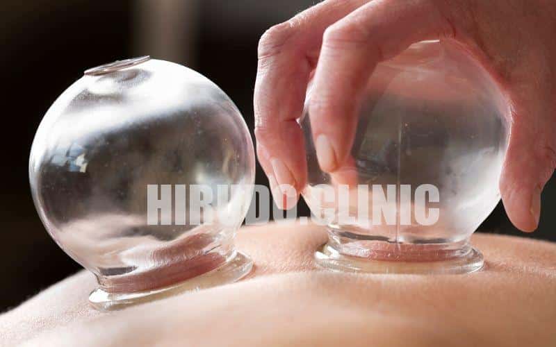 At Hirudo.clinic in Knightsbridge (SW1), we proudly offer the complete spectrum of cupping therapy techniques. invigorating flas Moving Cupping (Sliding Cupping)