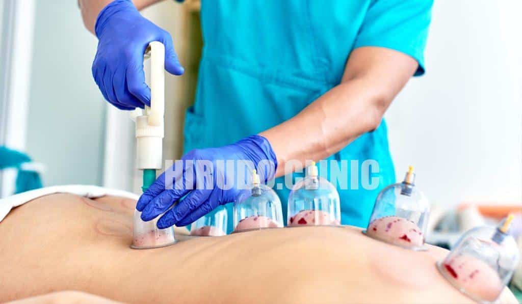 The skin is the body's first line of defense and is rich in immune cells. The gentle suction of the cups and the minor controlled incisions create a "sterile injury" or a "false alarm" at the site.