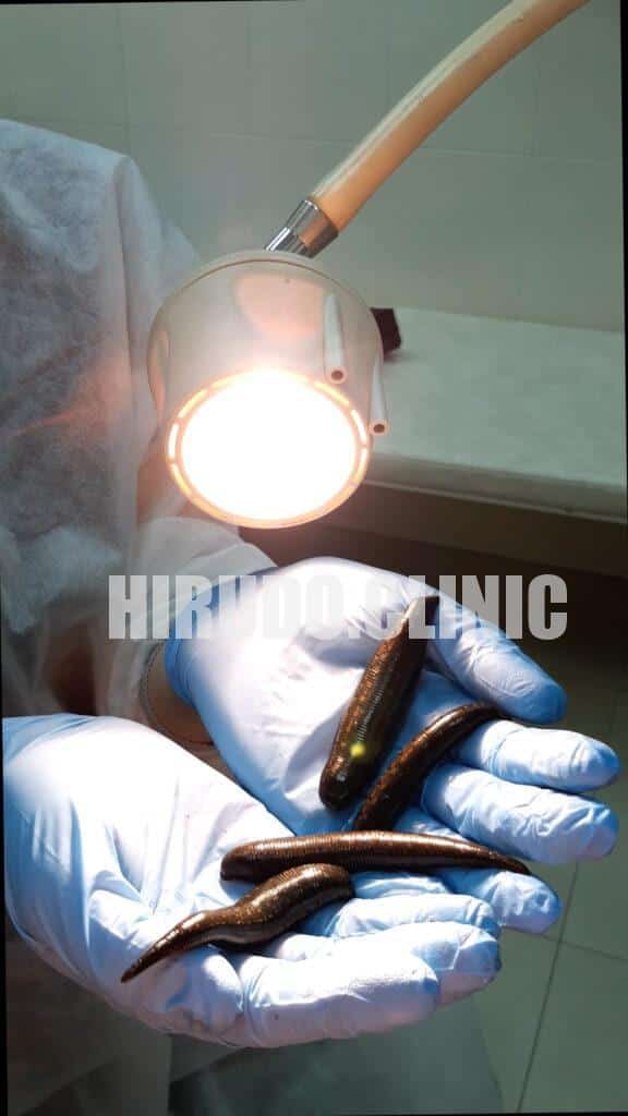 Medicinal leech therapy (MLT) offers a unique and natural approach to anti-aging by enhancing circulation, reducing inflammation, and supporting detoxification.