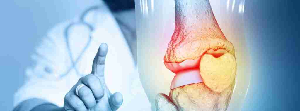 Leech Therapy for Knee Osteoarthritis in London
