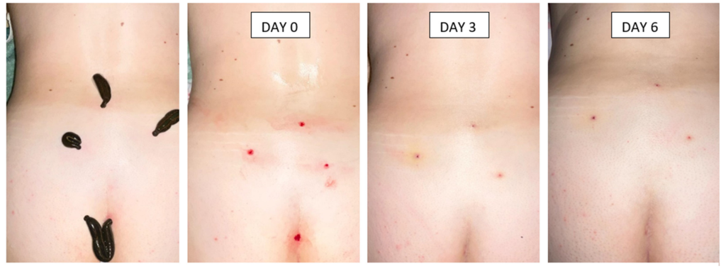 The image shows a sequence of four photos documenting the skin during and after a leech therapy session on the lower back sacral area.