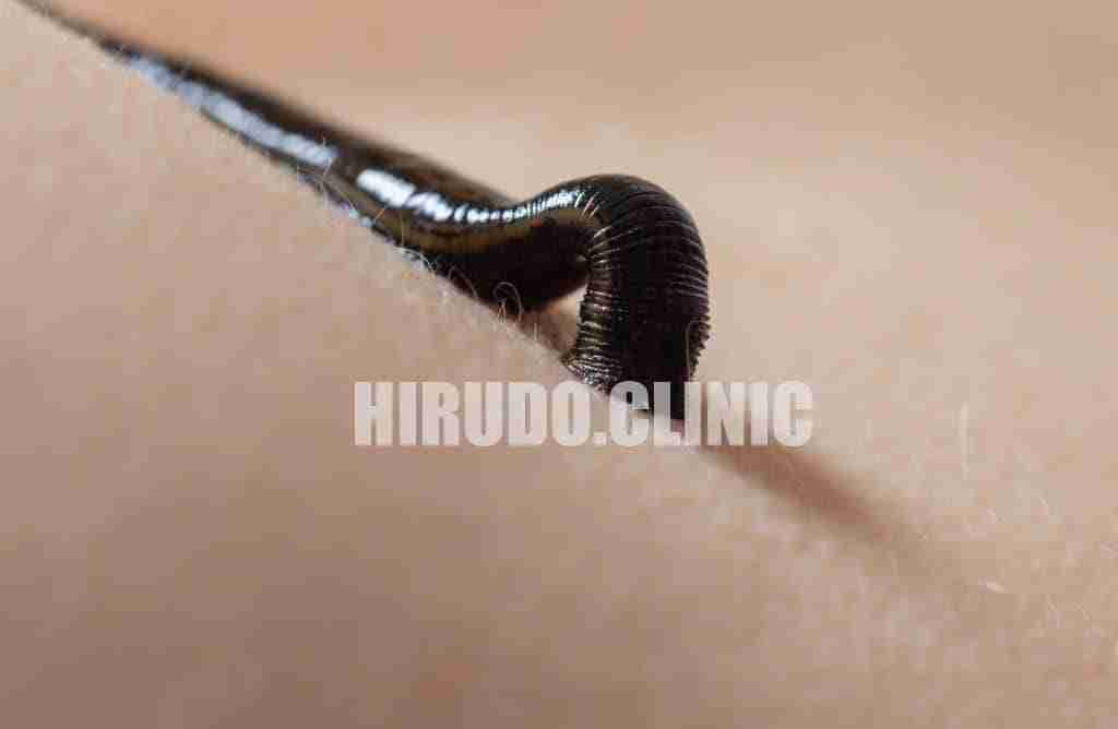 lmedicinal leech-therapy-1024x668 Natural support for pain, stiffness, and movement